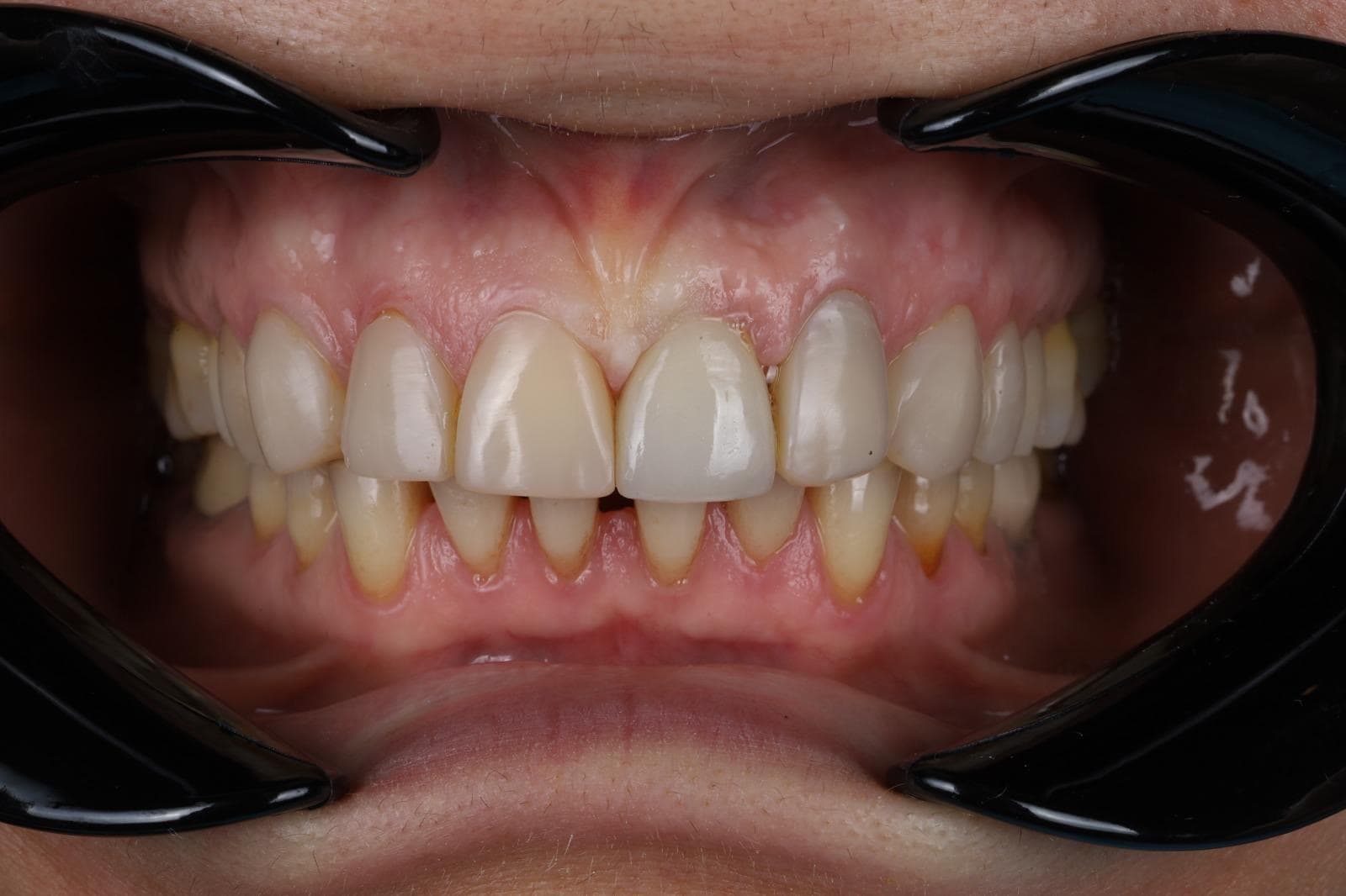 After — Implant and composite veneers