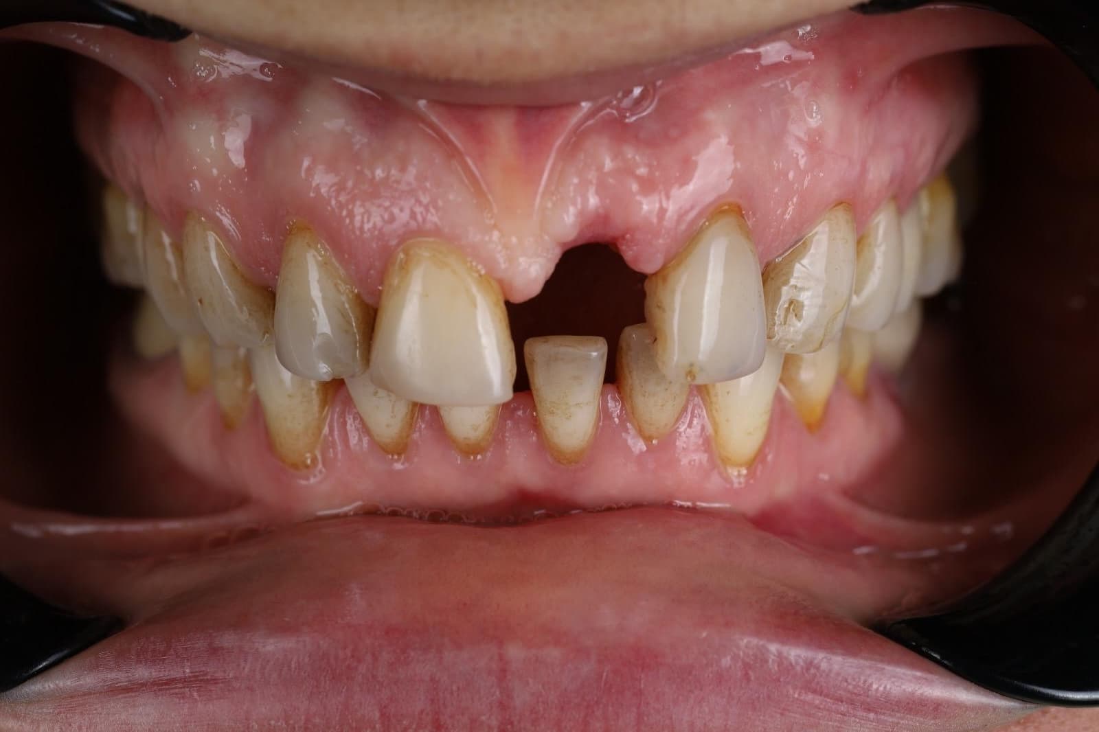 Before — Implant and composite veneers