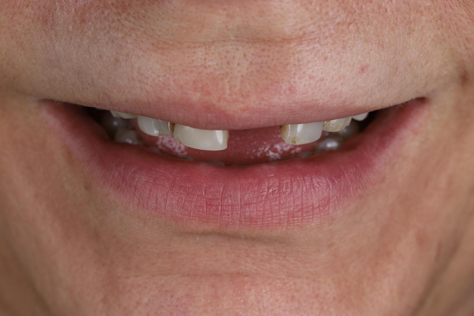 Before — missing tooth, implant abutment visible