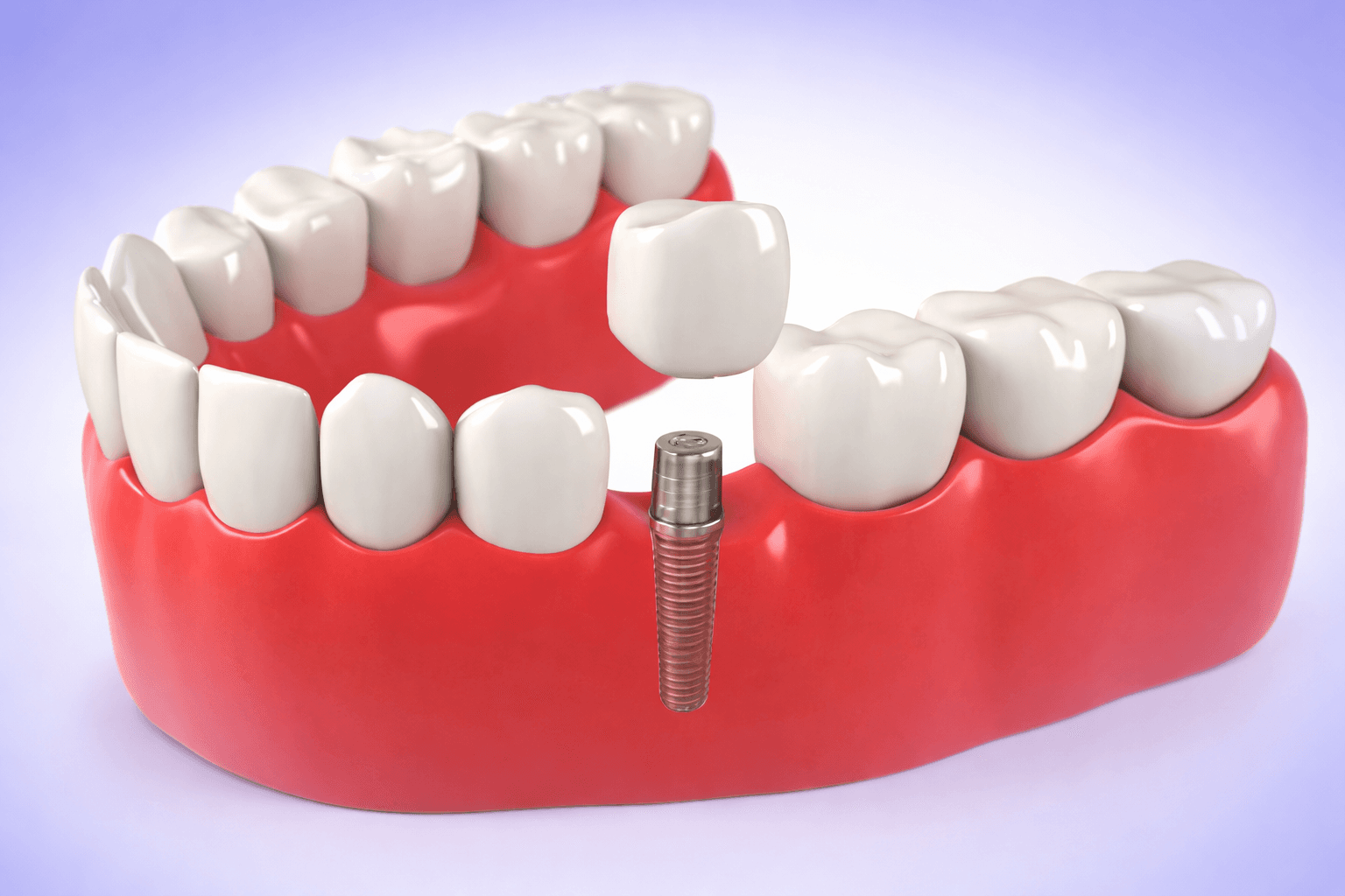 Educational 3D model of a dental implant post placed in the jaw beside natural teeth
