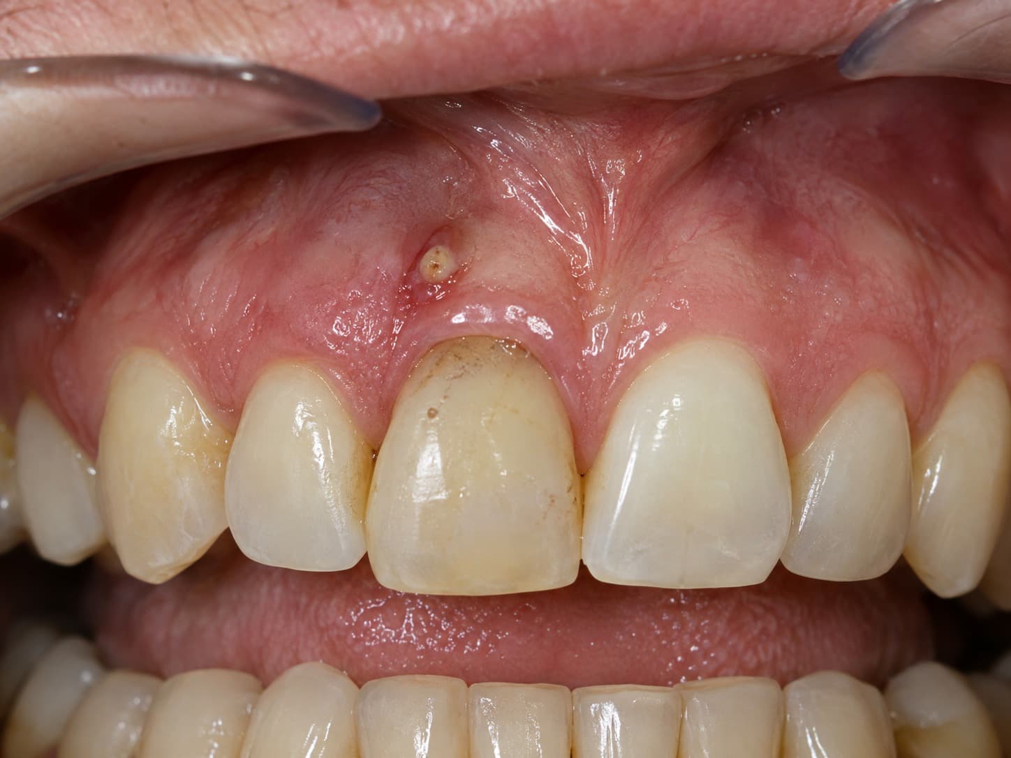 Close-up of a small draining gum fistula (pimple) on the gum above a discoloured upper front tooth