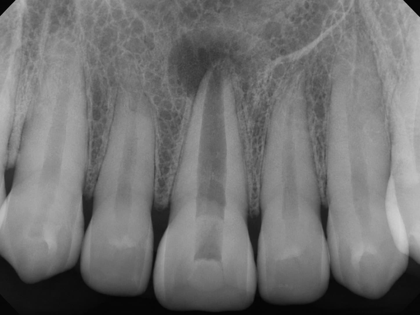 Periapical dental X-ray of the upper front teeth showing a dark area of bone loss around the root tip, consistent with a chronic apical abscess